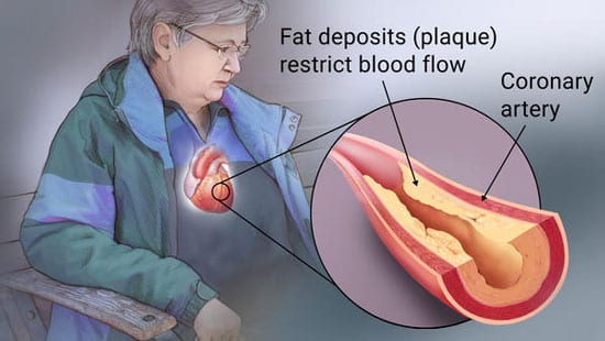 Coronary Artery Disease (CAD) fat deposits restrict blood flow