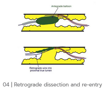 Antegrade balloon and retrograde wire into proximal true lumen for CTO PCI Hawaii